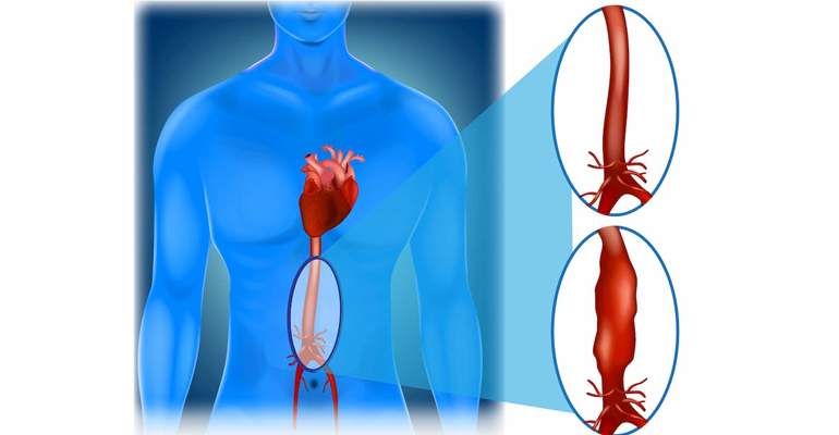 Aortic Surgeries for aortic dissection and aneurysm