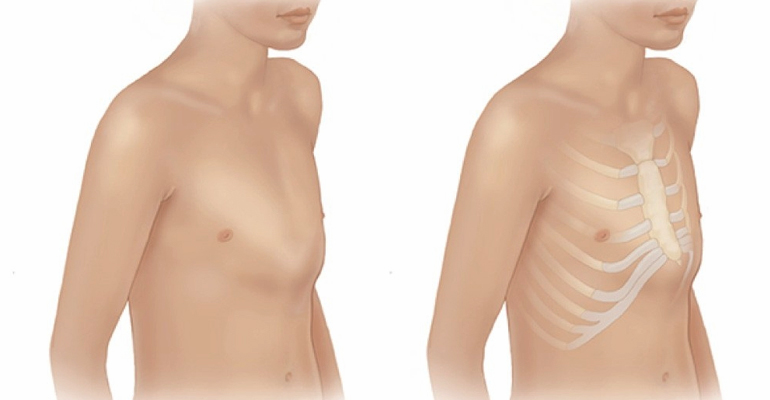 Chest Wall Surgeries for flail chest and rib fractures