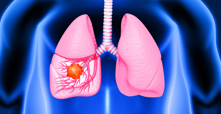 Lungs Surgery and coronary artery bypass surgery