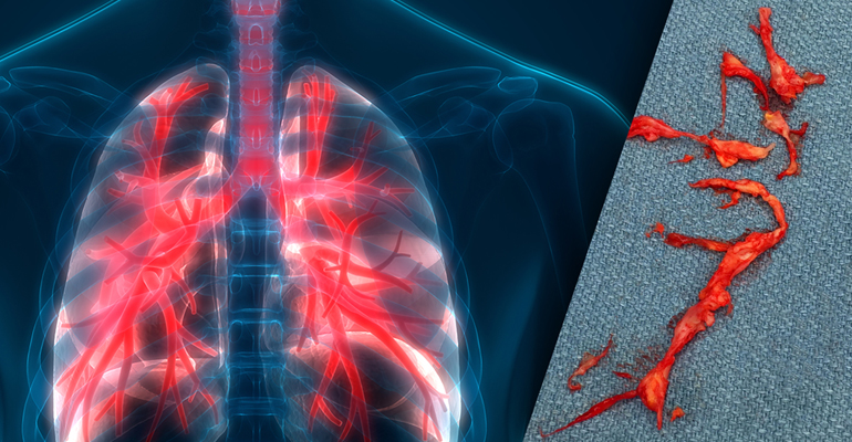 Pulmonary Endarterectomy for CTEPH surgery