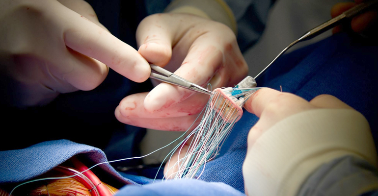 Heart Valve Surgeries - mitral, aortic, pulmonary, tricuspid repair